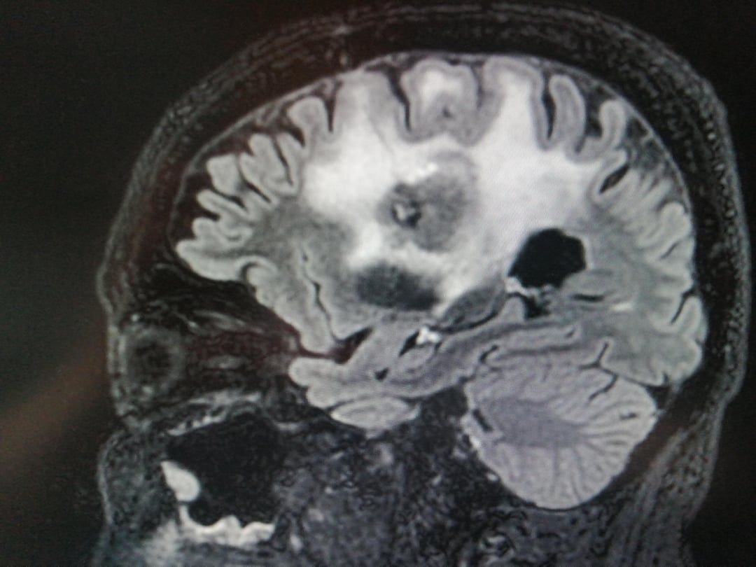 MRI Brain Scan